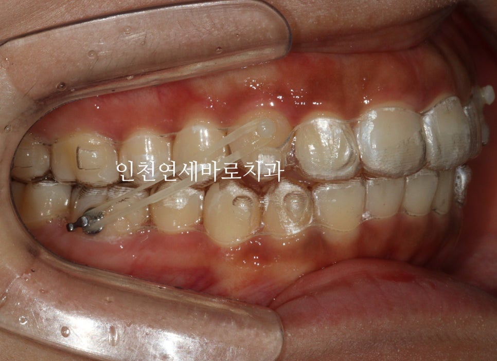 인비절라인 라이트 투명교정. 24년에 시작~24년에 끝
