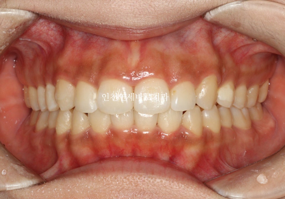 인비절라인 라이트 투명교정. 24년에 시작~24년에 끝
