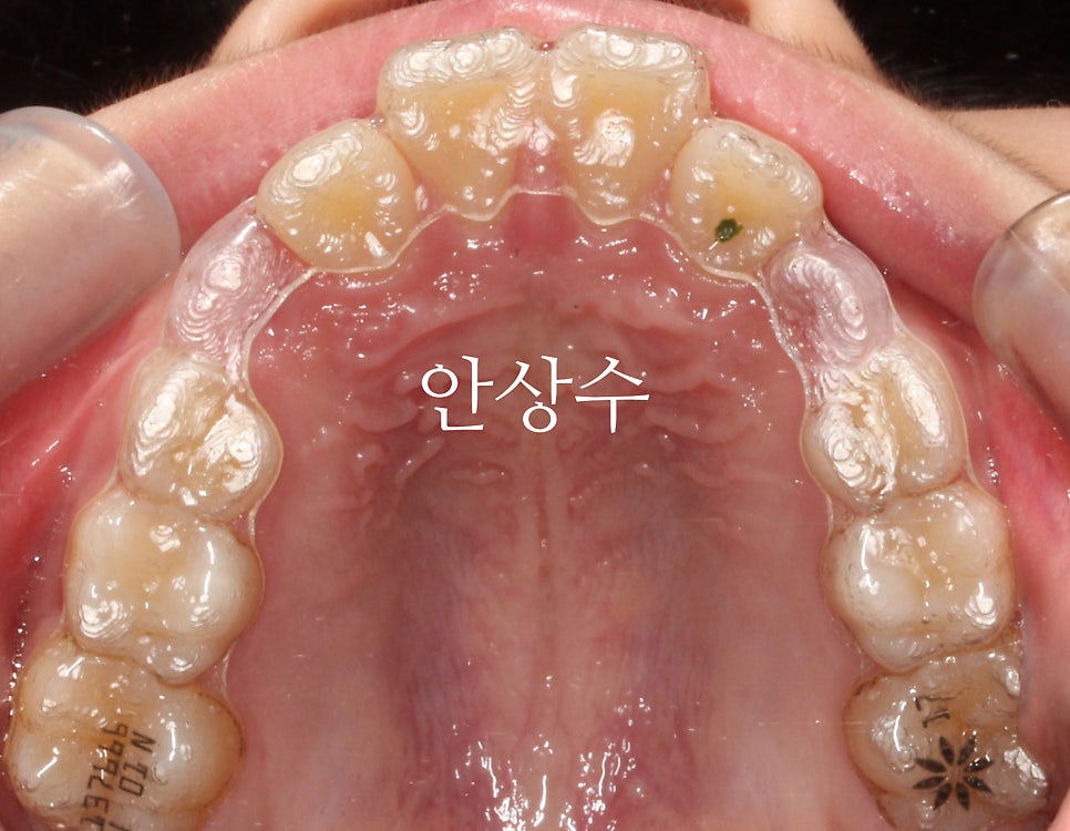 인비절라인 강연자가 알려주는 인비절라인 상식 몇가지 인천인비절라인 알아보시는 분들 필독입니다.