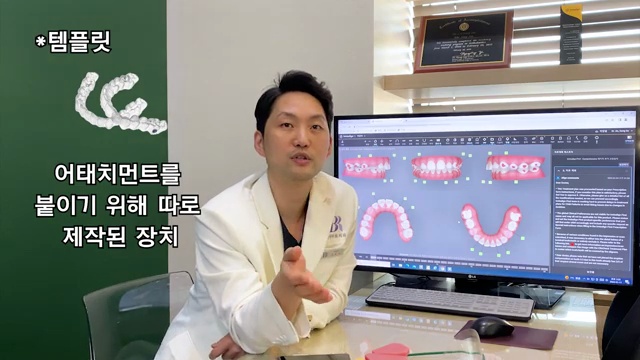 치과 위생사 조무사 등 치과종사자 교육 영상2탄, 인비절라인 어태치먼트 떨어졌을 때 주의사항