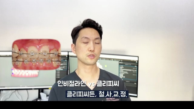 치아교정 장치 선택 인비절라인 / 클리피씨 가장 큰 차이는?
