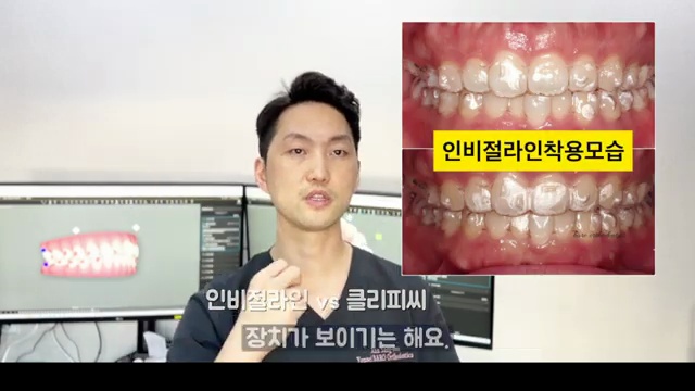 치아교정 장치 선택 인비절라인 / 클리피씨 가장 큰 차이는?