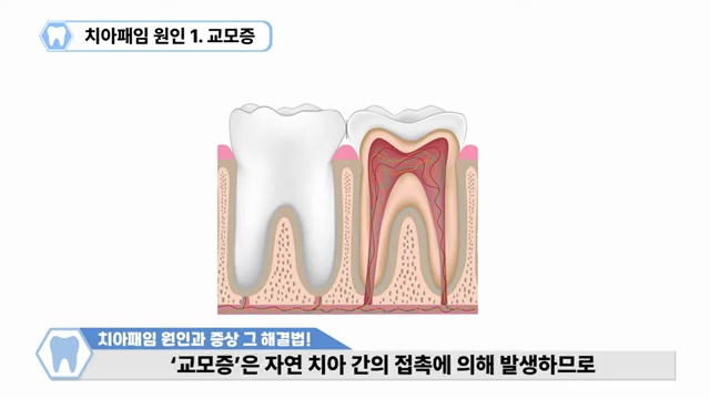 치아패임은 노화현상이 아닙니다!!