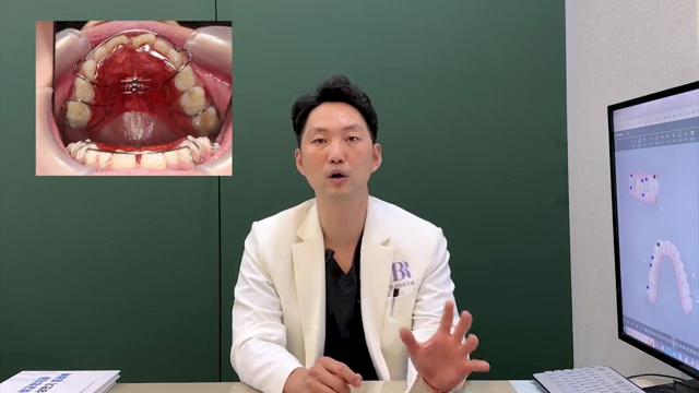 어린이 치아교정 고민이라면! 이 장치로 하세요! #어린이교정 #소아교정