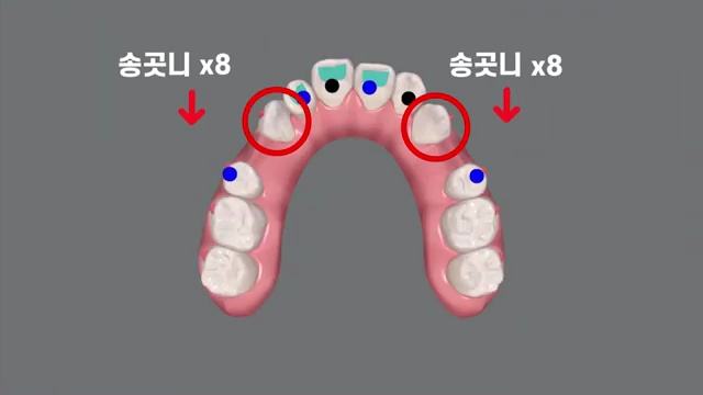 투명교정 인비절라인! 단계별로 아픈 부위가 다르다?!