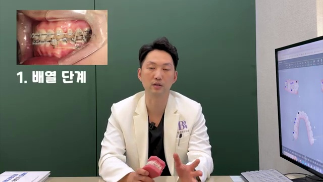 교정치료 중 고무줄 얼마동안 해야 할까?! #치아교정 #고무줄