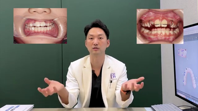 어린이 치아교정 고민이라면! 이 장치로 하세요! #어린이교정 #소아교정