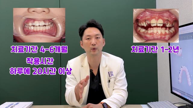 어린이 치아교정 고민이라면! 이 장치로 하세요! #어린이교정 #소아교정