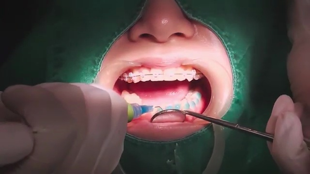 인비절라인 어태치먼트가 자꾸 떨어지는 이유와 해결법