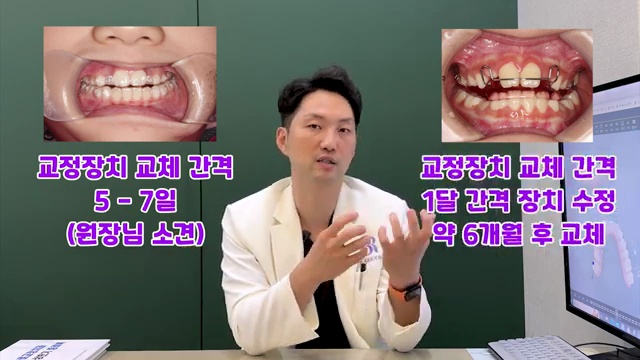 어린이 치아교정 고민이라면! 이 장치로 하세요! #어린이교정 #소아교정