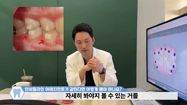 인비절라인 어태치먼트가 닳아서 없어지면 어떻게 해야 하나요???