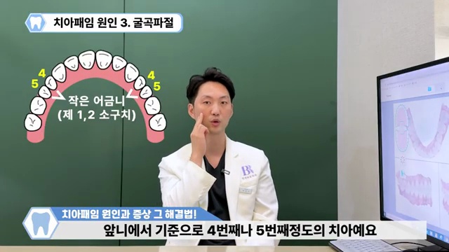 치아패임은 노화현상이 아닙니다!!