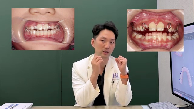 어린이 치아교정 고민이라면! 이 장치로 하세요! #어린이교정 #소아교정