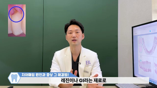 치아패임은 노화현상이 아닙니다!!