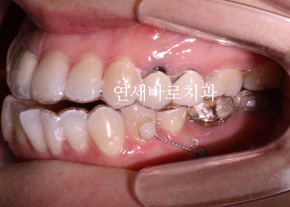 인비절라인 치료 시에도 미니스크류 필요할까?