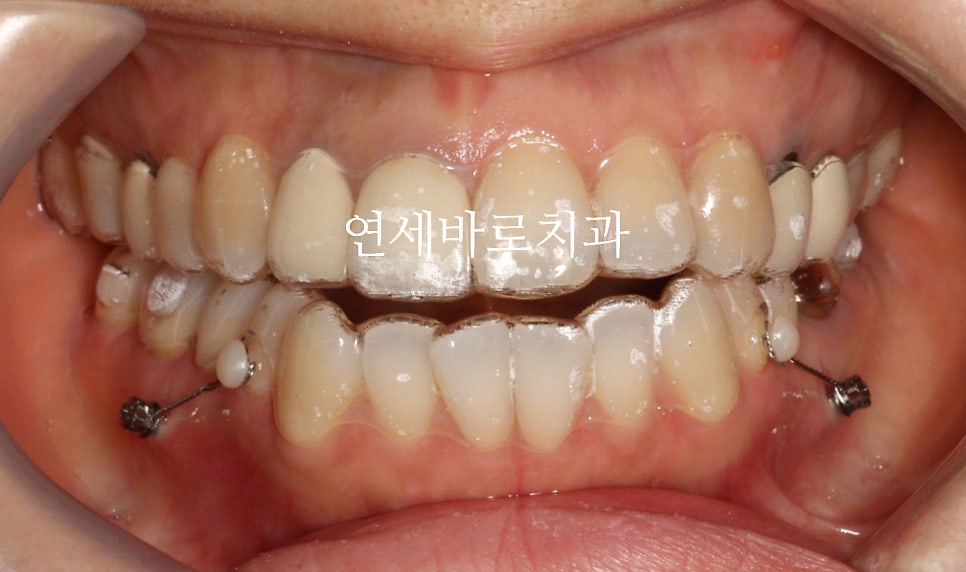 인비절라인 치료 시에도 미니스크류 필요할까?