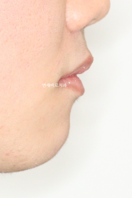 인천 교정치과 돌출입 전 후 비교