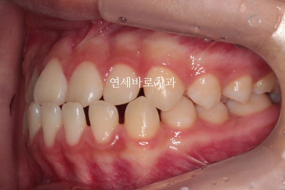 벌어진 앞니 인비절라인라이트 후기 및 부분교정과의 비교 장점 내용정리