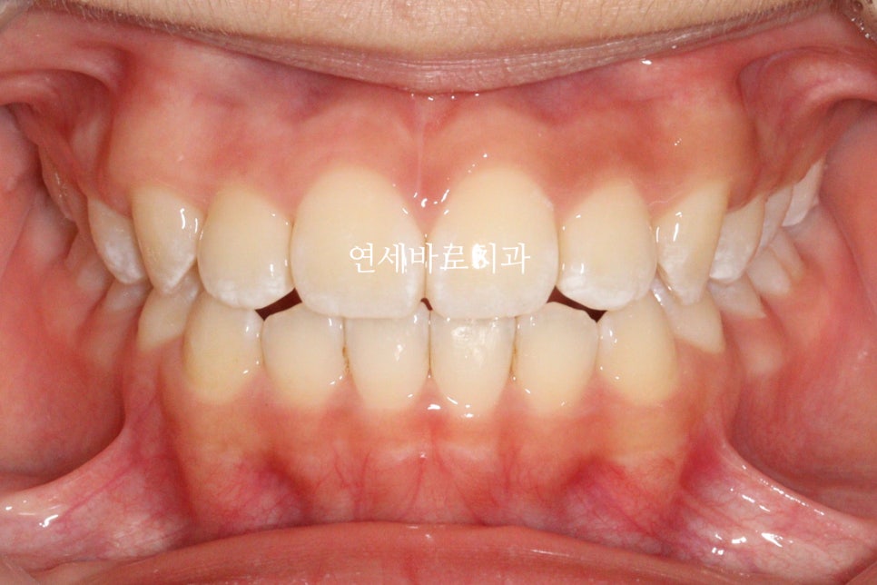 인비절라인 라이트 송곳니 교정 후기 및 재제작 시기 결정
