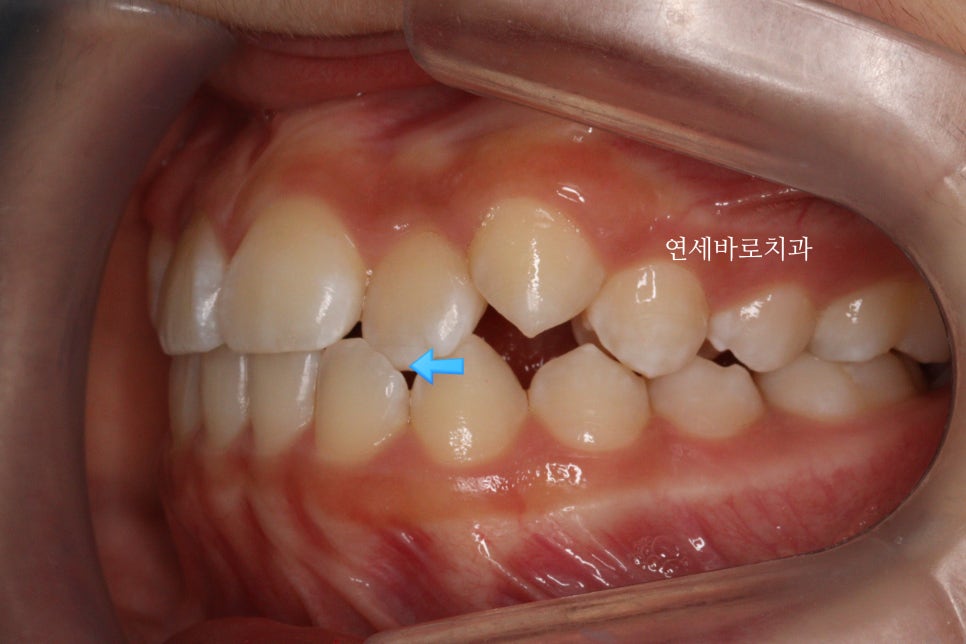 인비절라인 라이트 송곳니 교정 후기 및 재제작 시기 결정
