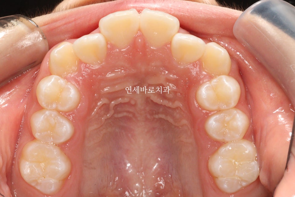 인비절라인 라이트 송곳니 교정 후기 및 재제작 시기 결정