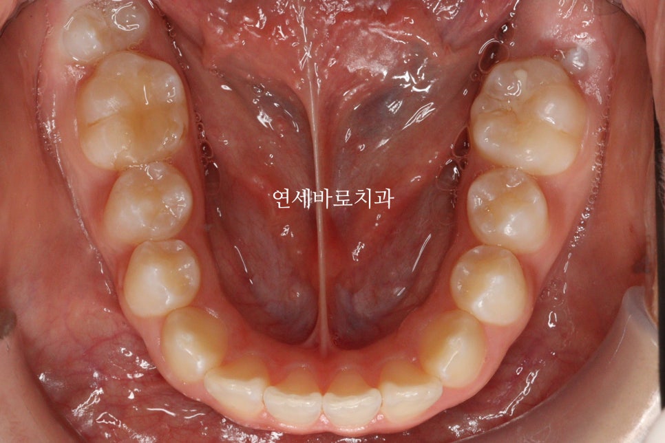 인비절라인 라이트 송곳니 교정 후기 및 재제작 시기 결정