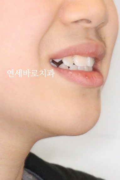 인비절라인 라이트 송곳니 교정 후기 및 재제작 시기 결정