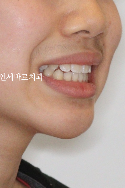 인비절라인 라이트 송곳니 교정 후기 및 재제작 시기 결정