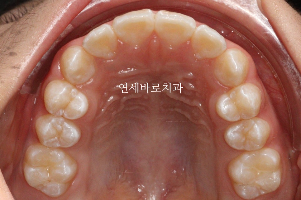 인비절라인 라이트 송곳니 교정 후기 및 재제작 시기 결정