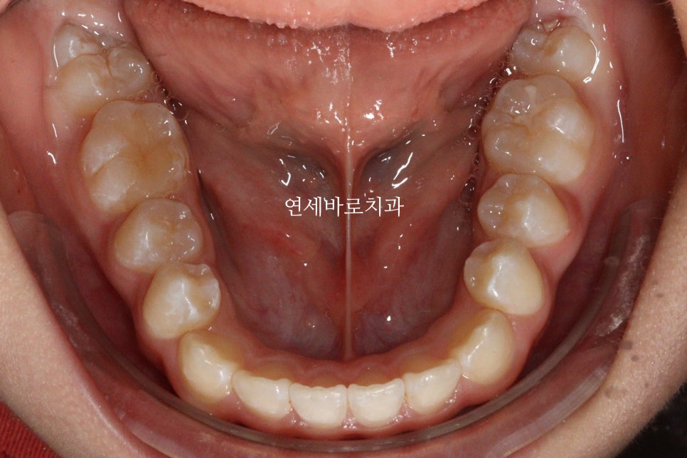 인비절라인 라이트 송곳니 교정 후기 및 재제작 시기 결정