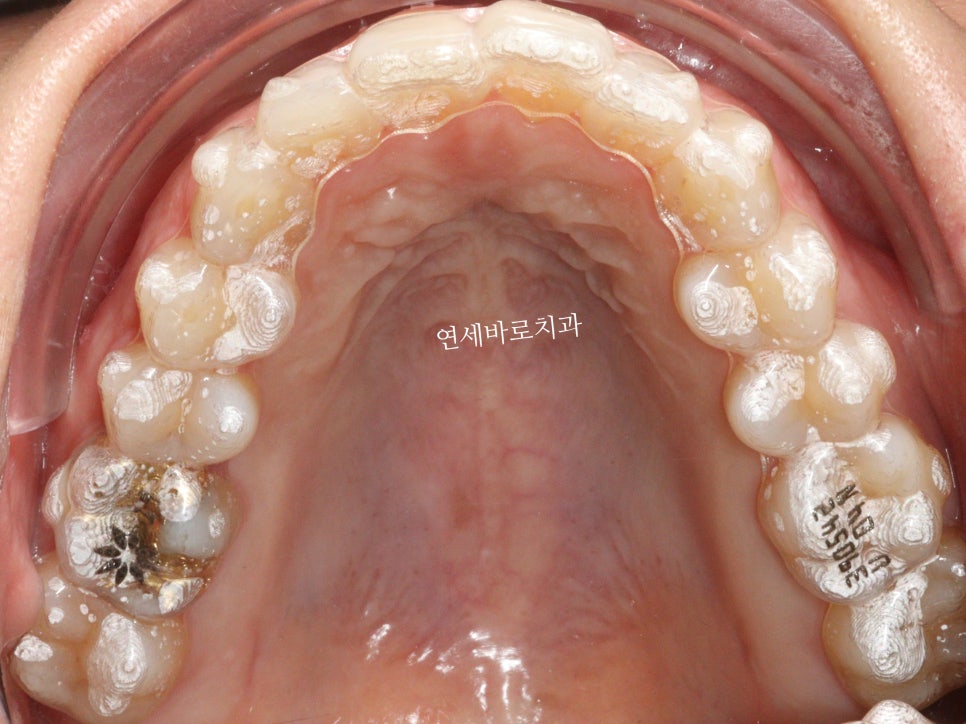 인비절라인 투명교정 내원간격에 대한 정리
