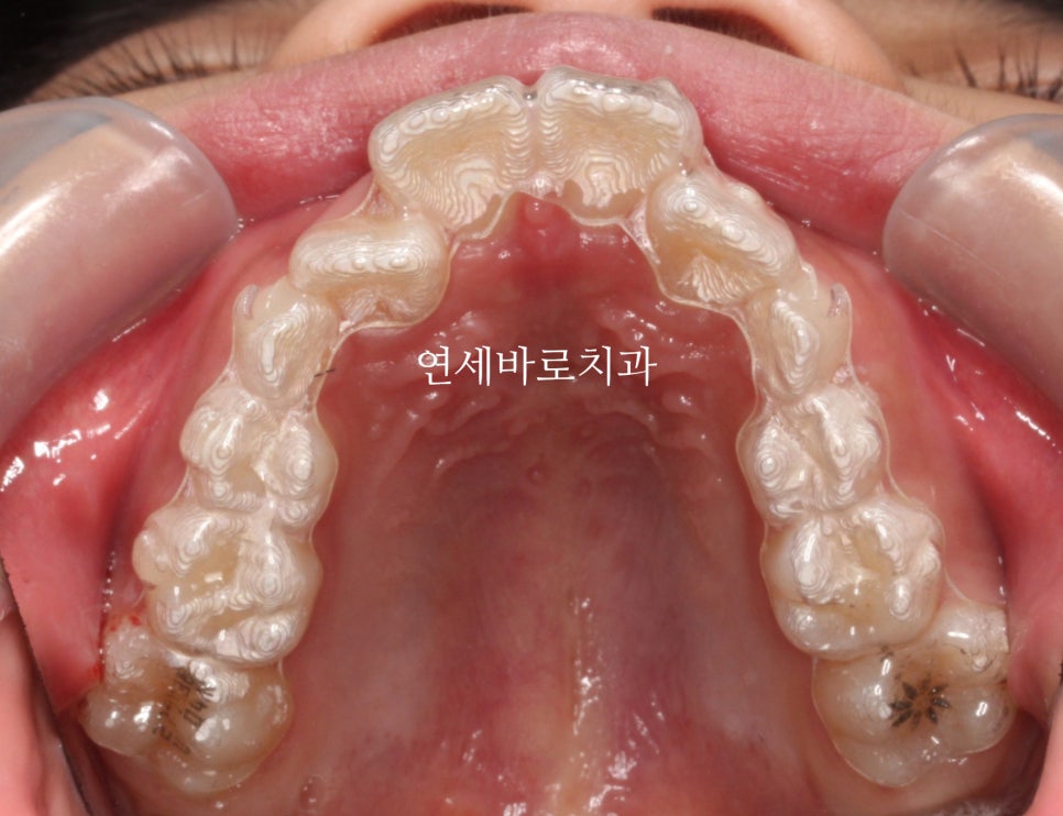 인비절라인 투명교정 내원간격에 대한 정리