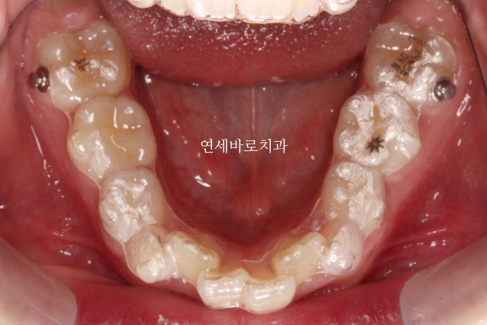 인비절라인 투명교정 내원간격에 대한 정리