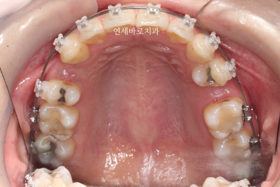 과개교합 돌출입 잇몸돌출 발치교정 클리피씨 전후 기록