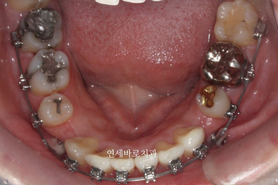 과개교합 돌출입 잇몸돌출 발치교정 클리피씨 전후 기록