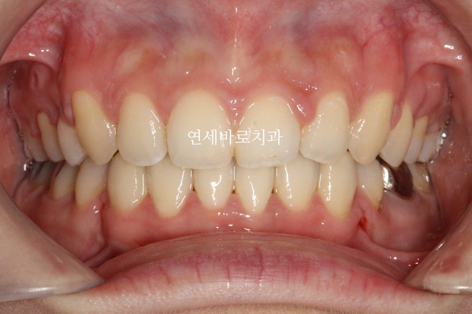 과개교합 돌출입 잇몸돌출 발치교정 클리피씨 전후 기록