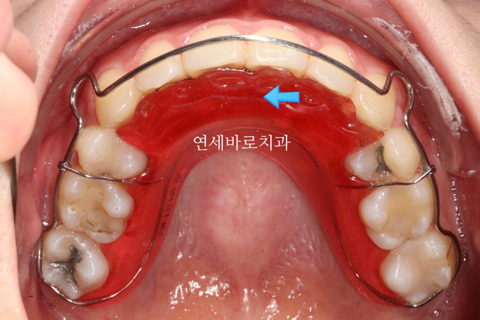 과개교합 돌출입 잇몸돌출 발치교정 클리피씨 전후 기록