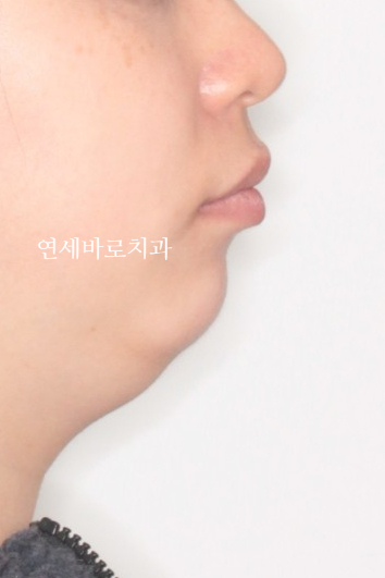 과개교합 돌출입 잇몸돌출 발치교정 클리피씨 전후 기록