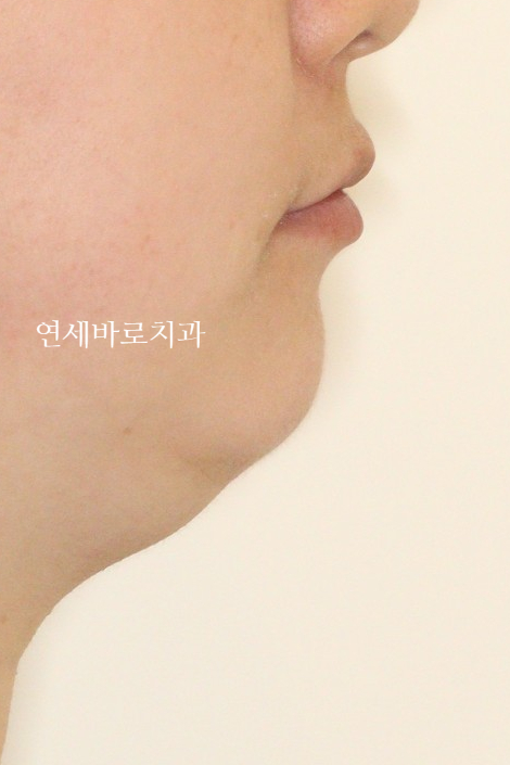 과개교합 돌출입 잇몸돌출 발치교정 클리피씨 전후 기록