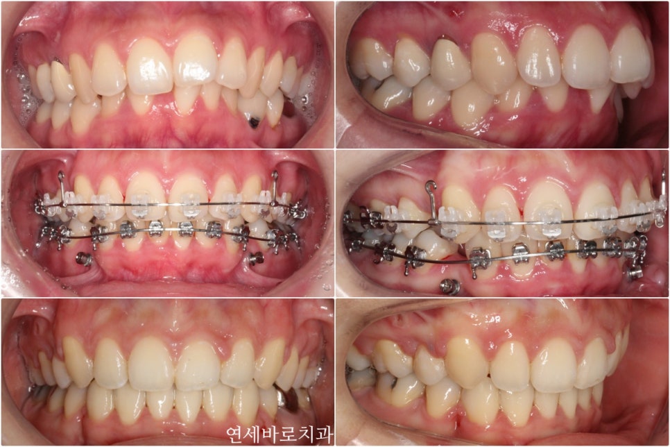 과개교합 돌출입 잇몸돌출 발치교정 클리피씨 전후 기록