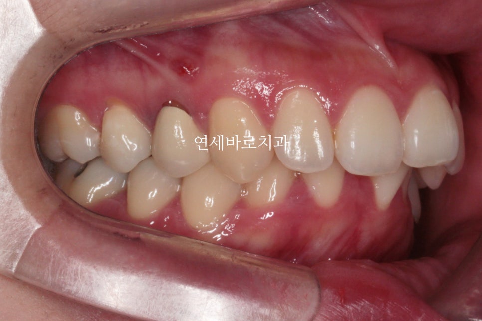 과개교합 돌출입 잇몸돌출 발치교정 클리피씨 전후 기록