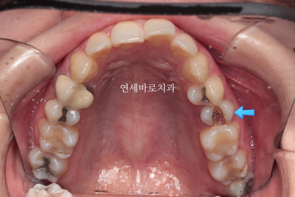 과개교합 돌출입 잇몸돌출 발치교정 클리피씨 전후 기록