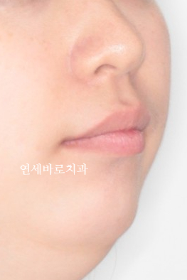 과개교합 돌출입 잇몸돌출 발치교정 클리피씨 전후 기록