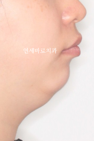 과개교합 돌출입 잇몸돌출 발치교정 클리피씨 전후 기록