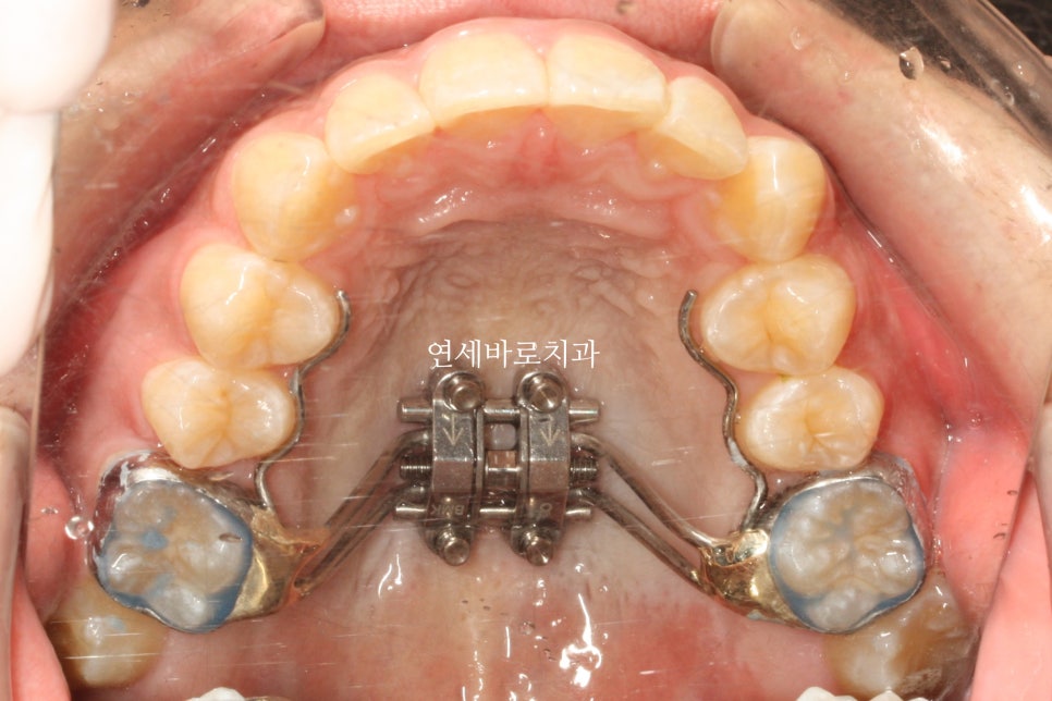 과개교합 MSE 악궁확장 치료 후기 및 장기간 안정성 관찰결과