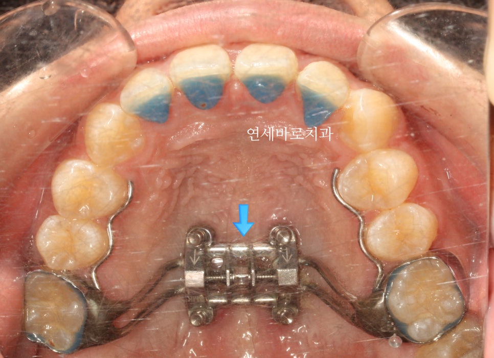 과개교합 MSE 악궁확장 치료 후기 및 장기간 안정성 관찰결과