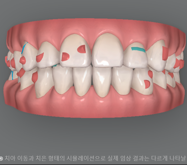 인비절라인 장치 재제작에 대한 모든 것