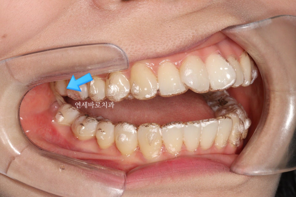 인비절라인 장치 재제작에 대한 모든 것