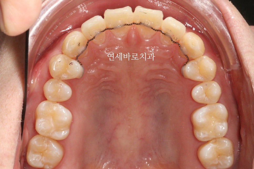 벌어진 치아교정 / 고정식 철사 유지장치의 필요성과 유지장치 이유