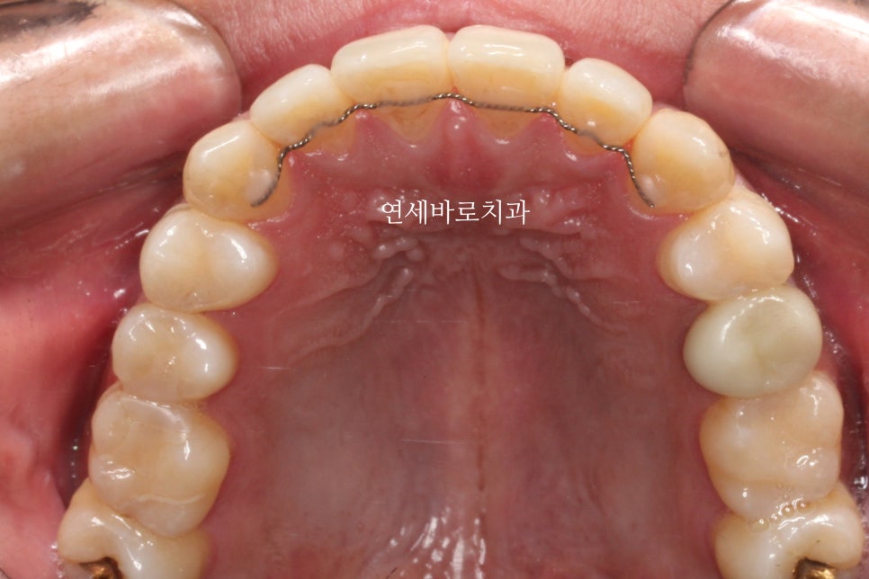 벌어진 치아교정 / 고정식 철사 유지장치의 필요성과 유지장치 이유
